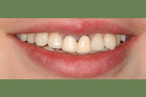 30 year old female, chief complaint — 'Old crowns that do not fit well.' <strong>Diagnosis:</strong> Decay and gum disease around old metal crowns. <strong>Treatment:</strong> Cosmetic gum surgery and porcelain crowns replaced two front teeth and veneers on upper lateral teeth.