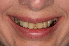 70 year old female, chief complaint — 'Aching teeth when chewing and teeth always breaking.' <strong>Diagnosis</strong>: Old dentistry and collapsed bite. <strong>Treatment:</strong> Full mouth reconstruction with all porcelain crowns.