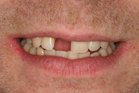 28 year old male, chief complaint — 'Missing front tooth from a childhood accident.' <strong>Diagnosis:</strong> Inadequate bone to support an implant. <strong>Treatment:</strong> Maryland bridge – a very conservative treatment to replace one missing tooth without an implant.