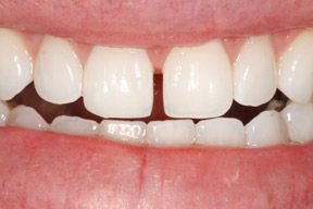 50 year old female, chief complaint — 'Big gap between my teeth that reopened after two orthodontic treatments.' <strong>Diagnosis:</strong> Diastema resulting from a mismatch between the upper and lower tooth size. <strong>Treatment:</strong> Veneers designed to fit in the space between the teeth. This is a very conservative approach that required no change to the patient's natural enamel.