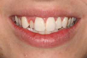 25 year old female, chief complaint — 'Really crooked teeth that make me embarrassed.' <strong>Diagnosis: </strong>Crowding. <strong>Treatment:</strong> Invisalign removable plastic aligners in one year.