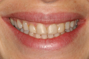 40 year old female, chief complaint — 'Short teeth that a dentist covered with bonding and became yellowed over time.' <strong>Diagnosis:</strong> Worn and stained resin veneers, teeth shortened by tooth grinding habit. <strong>Treatment:</strong> Porcelain veneers on upper front teeth that filled out the entire smile line.