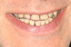 50 year old male, chief complaint — 'Spaces developed between my teeth.' <strong>Diagnosis:</strong> Collapsed bite due to heavy clenching habit. <strong>Treatment:</strong> Full mouth reconstruction in four primary visits.