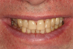 60 year old male, chief complaint — 'Constant headache pain from clenching, bridges cracked, teeth are yellow.' <strong>Diagnosis:</strong> Worn bite with old broken down crowns. <strong>Treatment:</strong> Full mouth reconstruction with all porcelain teeth.