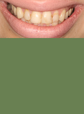
            <strong>What concerned the patient?</strong> &ldquo;I hate the way my teeth look&rdquo; and pain. <strong>Condition:</strong> Multiple large bonded fillings in front teeth were stained and her teeth hurt. By age 30, several front teeth had root canal treatments and were discolored.  Smile appeared slanted on one side. <strong>What was done:</strong> Cosmetically reshaped the gums  with a laser to balance the smile line with the lips.  Replaced all old dentistry in eight upper front teeth with new enamel-like, porcelain crowns to complete a natural smile design. <strong>Patient's Comments After Treatment:</strong> After a recent vacation in Florida a lot of people commented on how white her teeth look.
