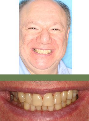 <strong>What concerned the patient?</strong> Facial pain from clenching. <strong>Pre-Treatment Condition:</strong> TMJ muscle pain from clenching and tooth grinding. Cracked bridgework. Diagnosis &mdash; collapsed bite. <strong>What was done:</strong> At the first visit we built up all the teeth to their natural size with bonding material to show Robert that the concept of balancing the bite would relax the TMJ muscles.  It worked!  Once Robert was confident with the goal we replaced all old dentistry with new enamel-like, all-ceramic crowns; restored all worn-down teeth to their natural shape and size; balanced the bite on all teeth to prevent excessive biting habit on back teeth.  Six primary office visits. <strong>Patient's Comments After Treatment:</strong> Robert reported his clenching habit is dramatically improved and he goes for days without thinking about his teeth. This was compared to several painful headaches each day before his new set of teeth. He is very pleased with the cosmetics of the work.